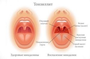 тонзиліт
