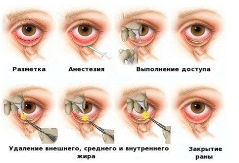 Блефаропластика 3