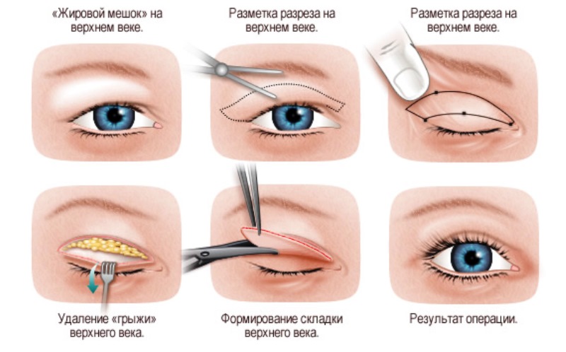 Блефаропластика 2